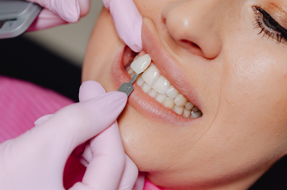 Lente de contato dental: o que é e quem pode