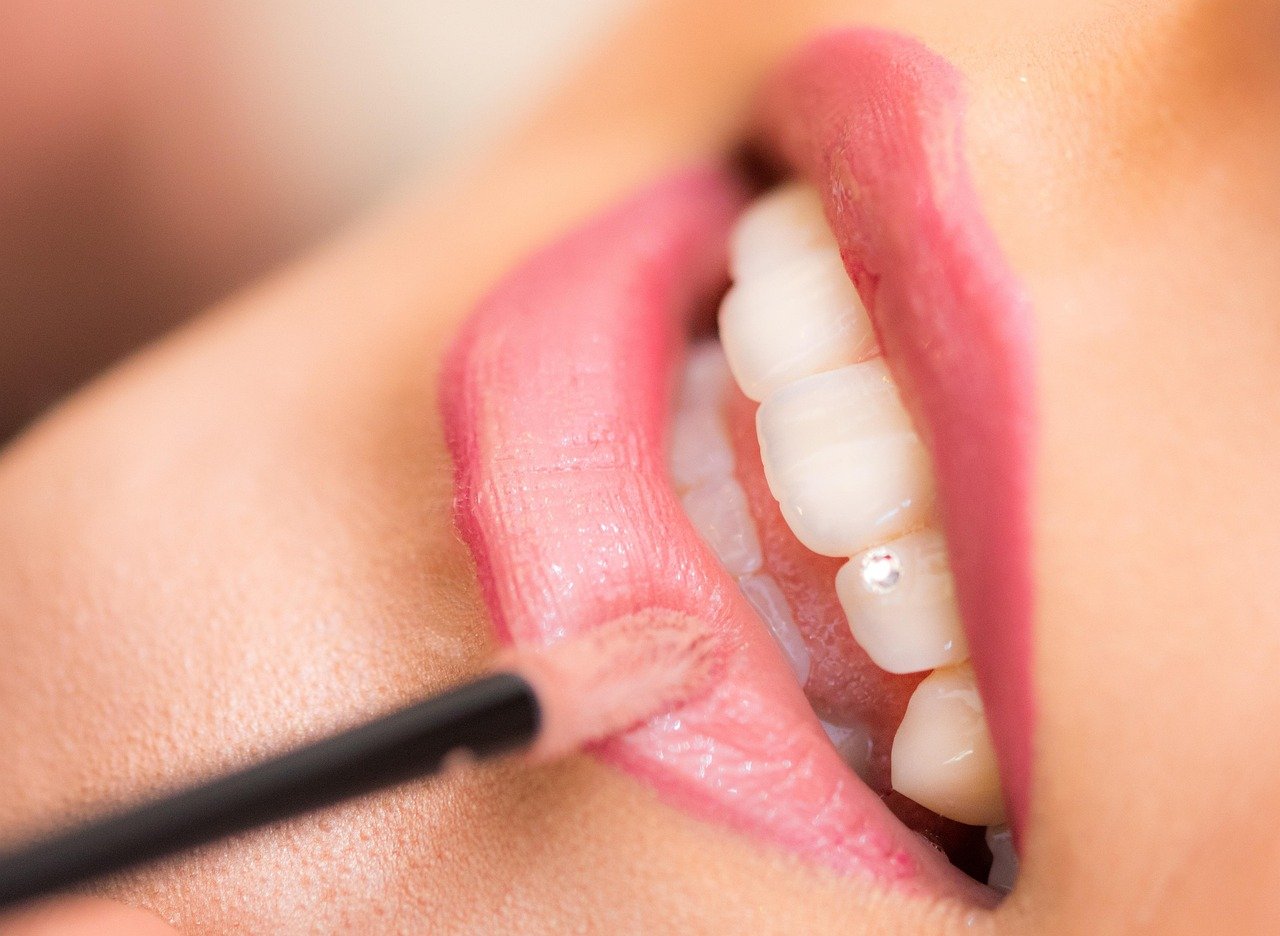 Clareamento dental: caseiro ou no dentista?